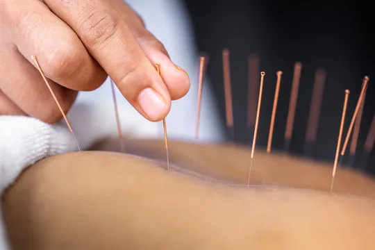 Aplicação de agulhas de acupuntura nas costas de uma pessoa deitada.