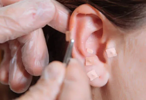 Colocação de um ponto de estímulo no pavilhão auricular de uma paciente.